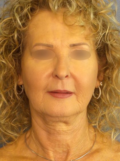 Facelift Before & After Patient #891