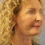 Facelift Before & After Patient #891