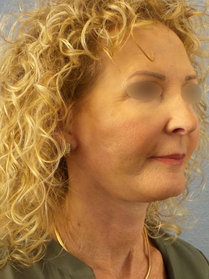 Facelift Before & After Patient #891
