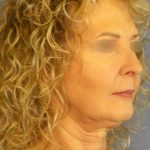 Facelift Before & After Patient #891