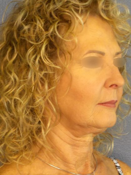 Facelift Before & After Patient #891