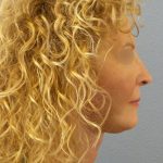 Facelift Before & After Patient #891