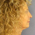 Facelift Before & After Patient #891