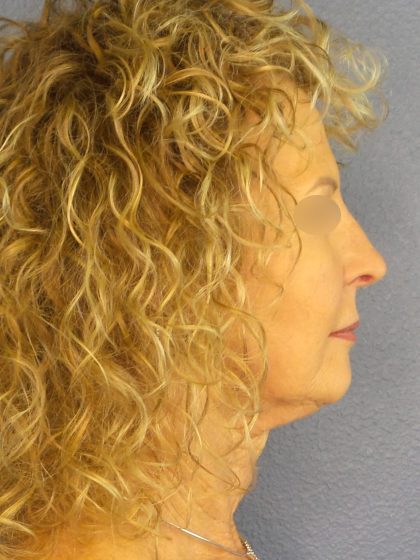 Facelift Before & After Patient #891