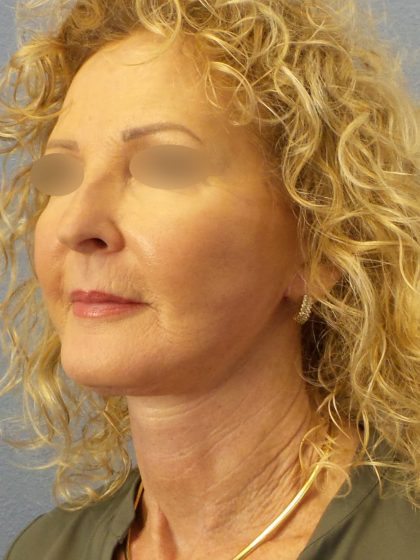 Facelift Before & After Patient #891