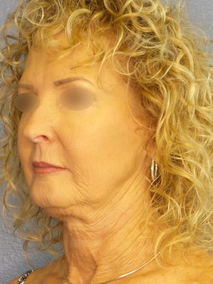 Facelift Before & After Patient #891