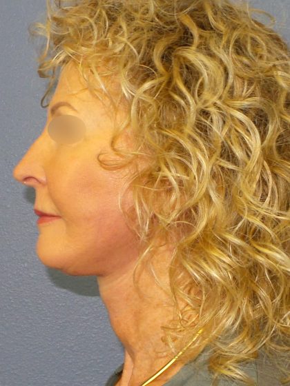 Facelift Before & After Patient #891