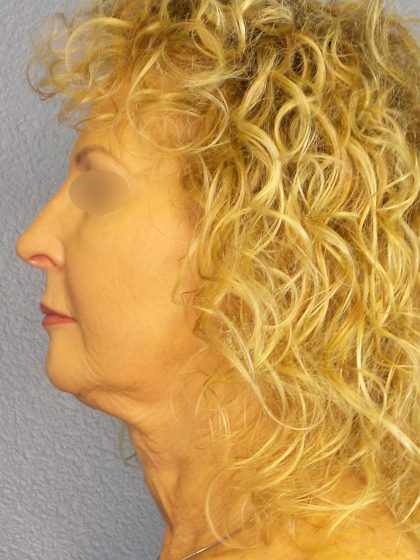 Facelift Before & After Patient #891