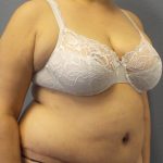 Abdominoplasty Before & After Patient #2181