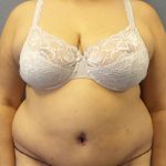 Abdominoplasty Before & After Patient #2181