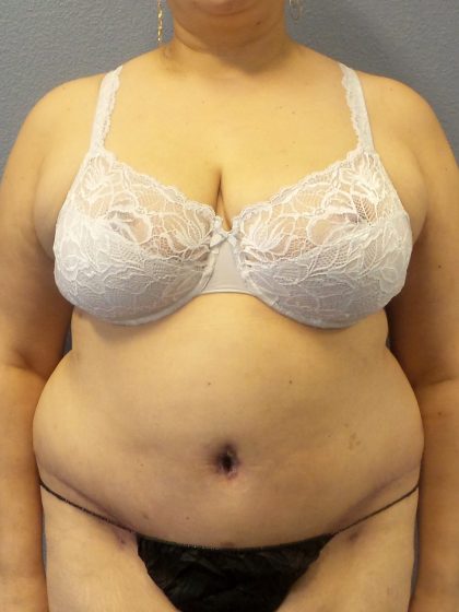 Abdominoplasty Before & After Patient #2181