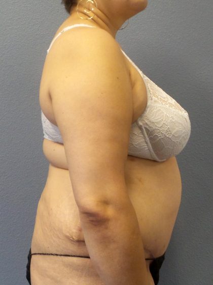 Abdominoplasty Before & After Patient #2181