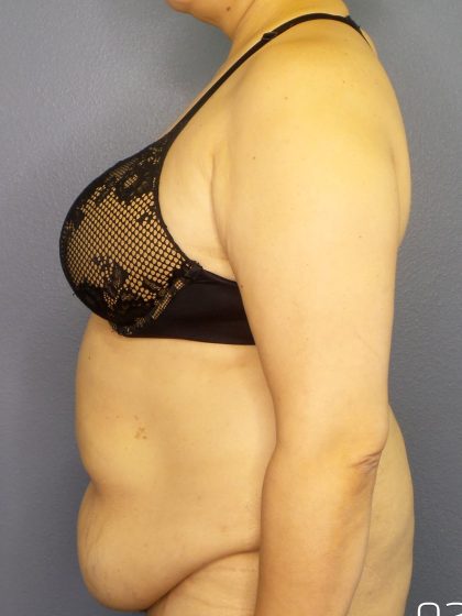 Abdominoplasty Before & After Patient #2181