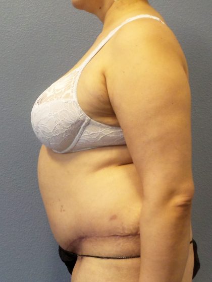 Abdominoplasty Before & After Patient #2181