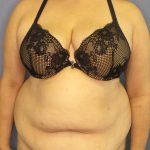 Abdominoplasty Before & After Patient #2181