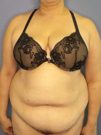 Abdominoplasty Before & After Patient #2181