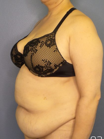 Abdominoplasty Before & After Patient #2181