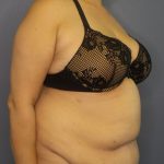 Abdominoplasty Before & After Patient #2181