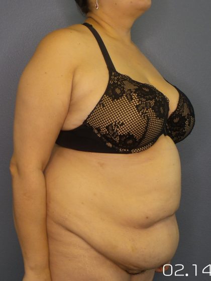 Abdominoplasty Before & After Patient #2181