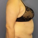 Abdominoplasty Before & After Patient #2181