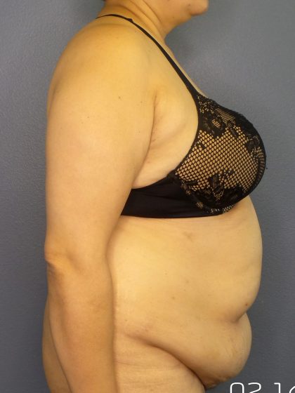Abdominoplasty Before & After Patient #2181