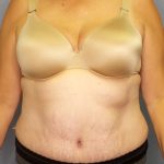 Abdominoplasty Before & After Patient #2067