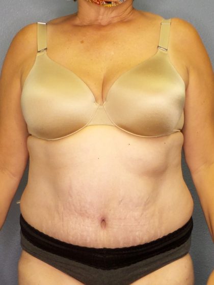 Abdominoplasty Before & After Patient #2067