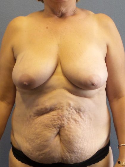 Abdominoplasty Before & After Patient #2067