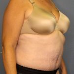 Abdominoplasty Before & After Patient #2067