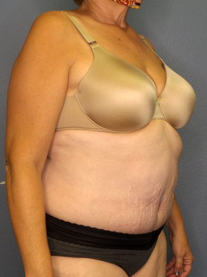 Abdominoplasty Before & After Patient #2067