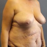 Abdominoplasty Before & After Patient #2067