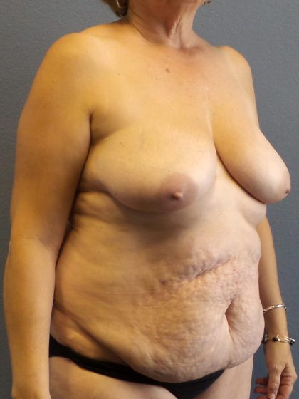 Abdominoplasty Before & After Patient #2067