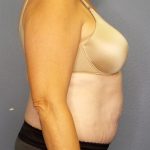 Abdominoplasty Before & After Patient #2067