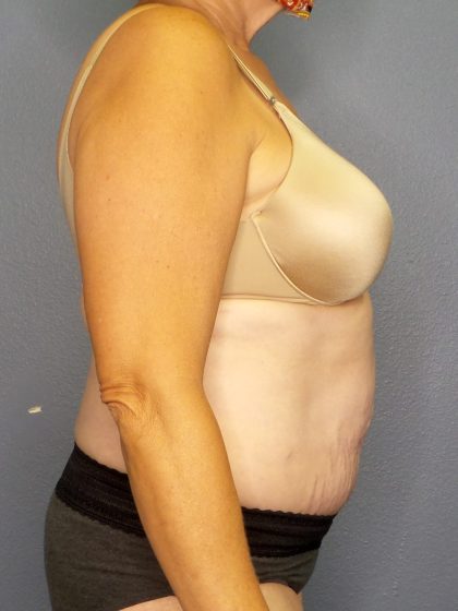 Abdominoplasty Before & After Patient #2067