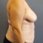 Abdominoplasty Before & After Patient #2067