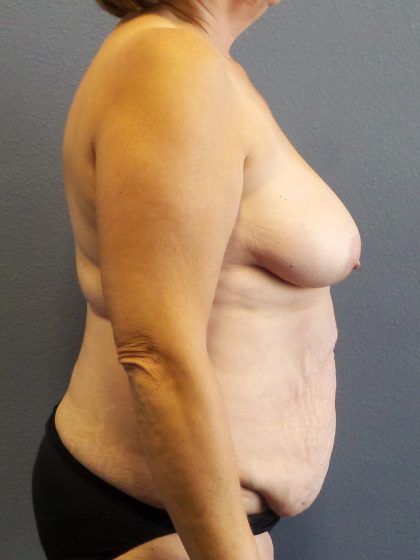 Abdominoplasty Before & After Patient #2067