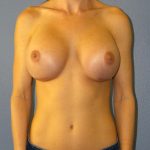 Breast Augmentation Revision (Breast Enlargement Repair) Before & After Patient #679