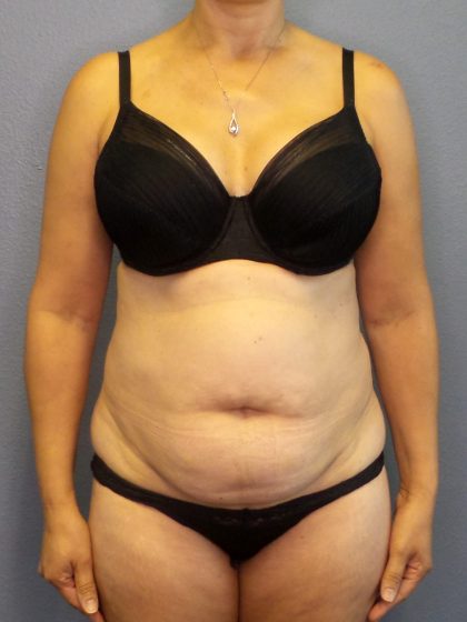 Abdominoplasty Before & After Patient #2197