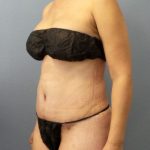 Abdominoplasty Before & After Patient #2197