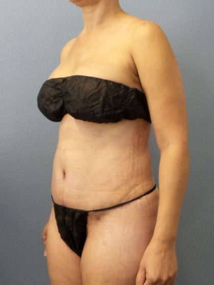 Abdominoplasty Before & After Patient #2197