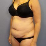 Abdominoplasty Before & After Patient #2197