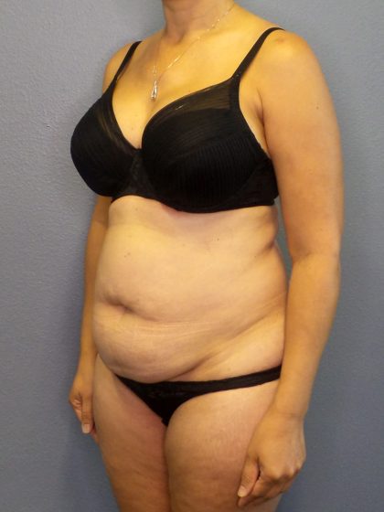 Abdominoplasty Before & After Patient #2197