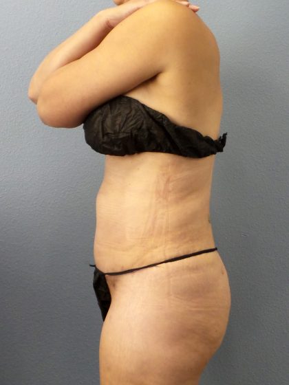 Abdominoplasty Before & After Patient #2197
