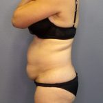 Abdominoplasty Before & After Patient #2197