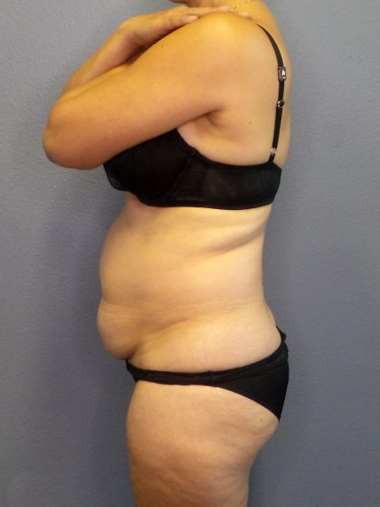 Abdominoplasty Before & After Patient #2197