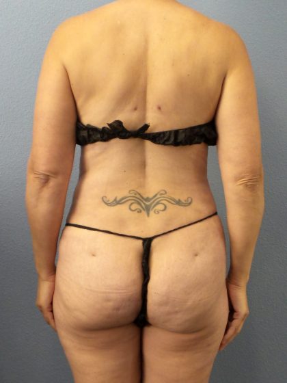 Abdominoplasty Before & After Patient #2197