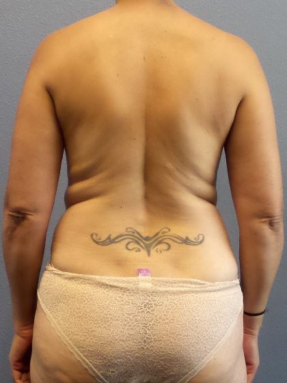 Abdominoplasty Before & After Patient #2197