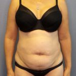 Liposuction Female Before & After Patient #1221