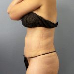 Liposuction Female Before & After Patient #1221