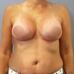 Breast Augmentation Before & After Patient #1411